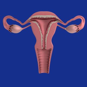What is Ovarian Cancer