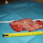 Removed Cancerous Tumor Photo 1