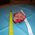 Removed Cancerous Tumor Photo 2