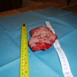 Removed Cancerous Tumor Photo 2