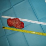 Removed Cancerous Tumor Photo 3