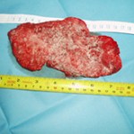 Removed Cancerous Tumor Photo 4