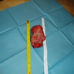 Removed Cancerous Tumor Photo 5