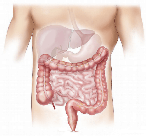 Colon Cancer