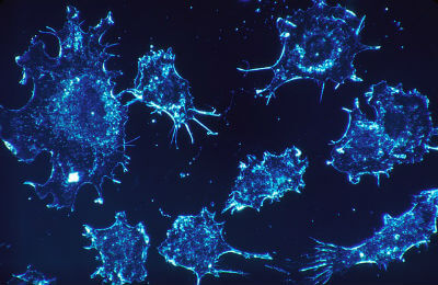 Microscopic view of Mantle Cell Lymphoma
