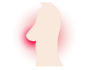 breast cancer